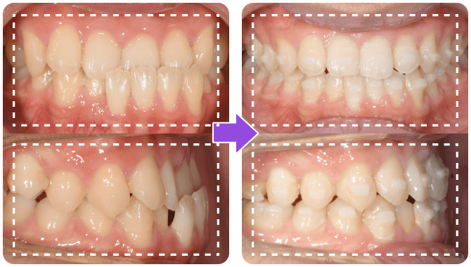 before after