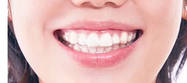 笑った時に見える部分に特化したプラン