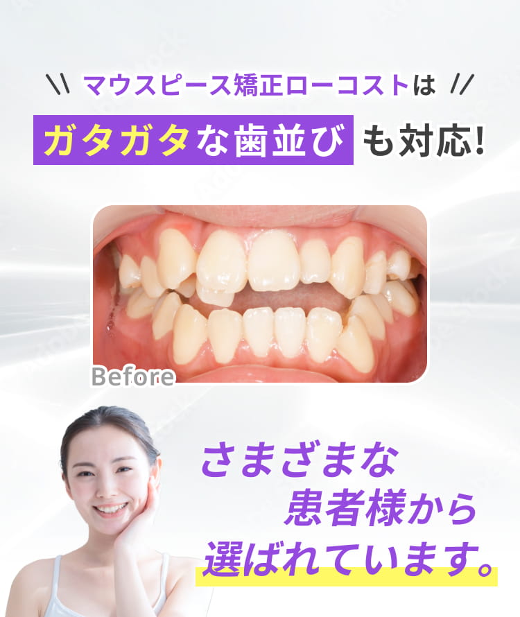 マウスピース矯正ローコストはガタガタな歯並びにも対応!